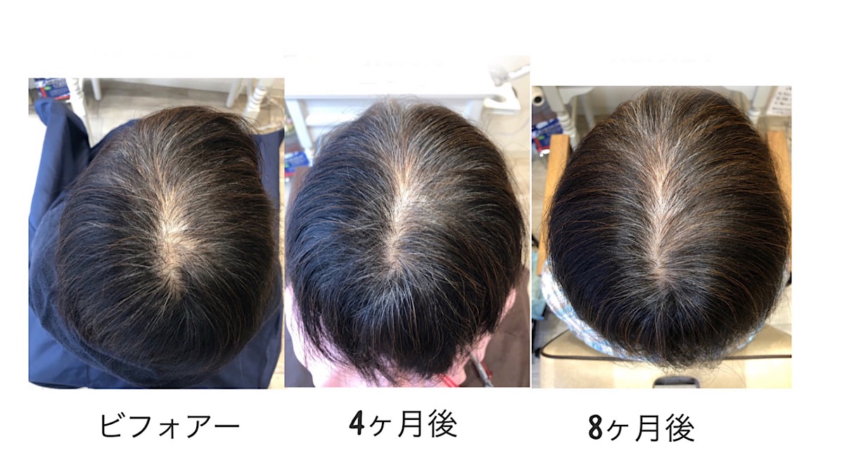 スペシャル育毛ヘッドスパ